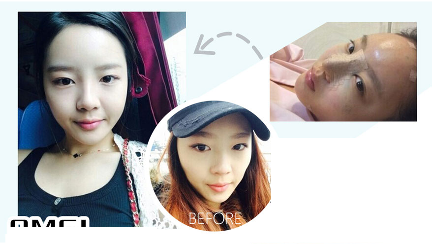 forehead filling case one