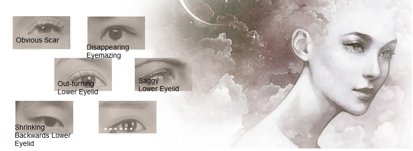 revisional eyebag removal