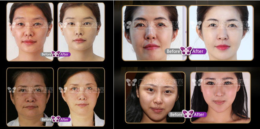 PPDO facial lifting